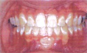 Poor oral hygiene