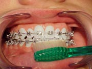 Brushing with braces