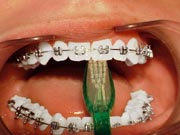 Brushing with braces
