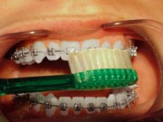 Orthodontic tooth brushing