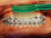 Orthodontic tooth brushing