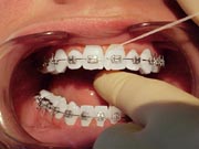 Flossing with braces