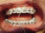 Flossing with braces