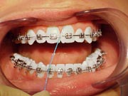 Orthodontic flossing