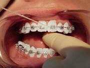 Orthodontic flossing