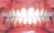 Proper oral hygiene