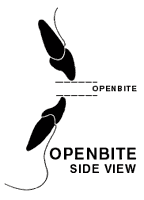 Openbite