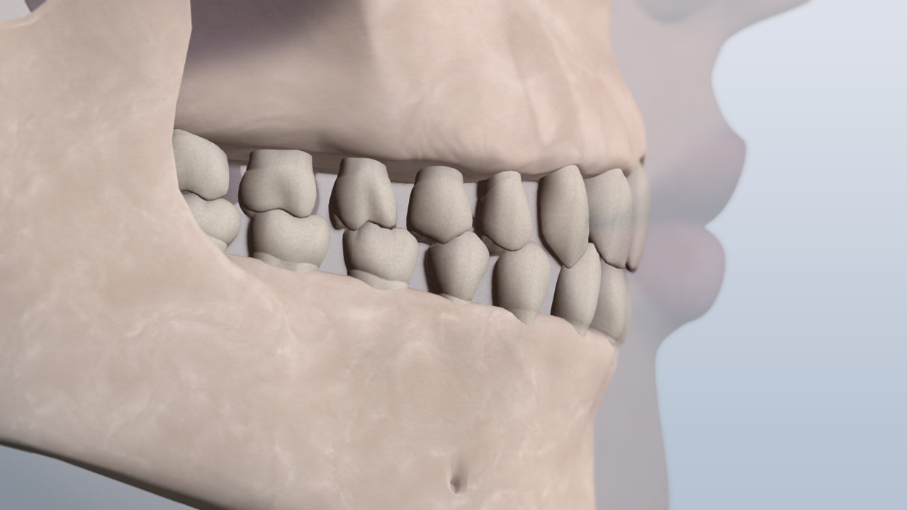 Spacing bite illustration