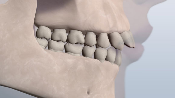 Division 1 bite illustration