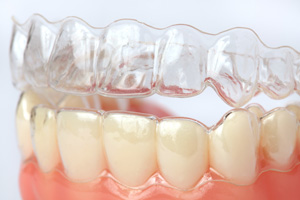 Clear aligners