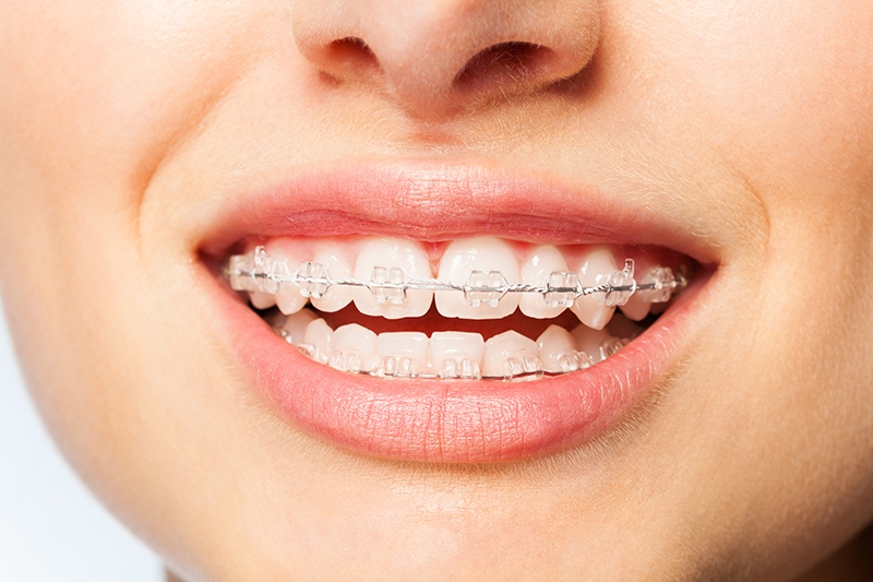 Clear ceramic braces